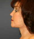 Feel Beautiful - Necklift and Lips - After Photo